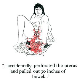 [perforated_uterus.JPG]