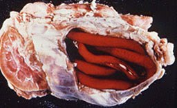Giant Kidney Worm