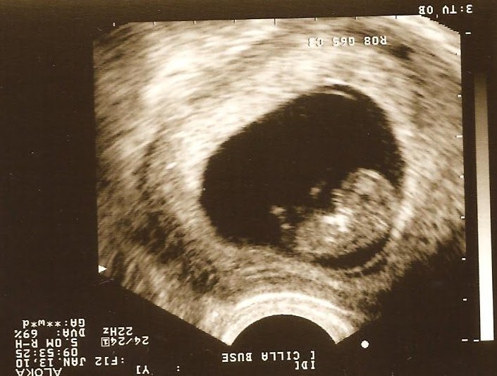 It only takes one time&hellip;Not! 10 Week Ultrasound