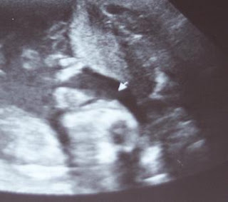 anencephaly ultrasound images
