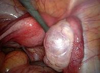 Ovarian Cyst Picture