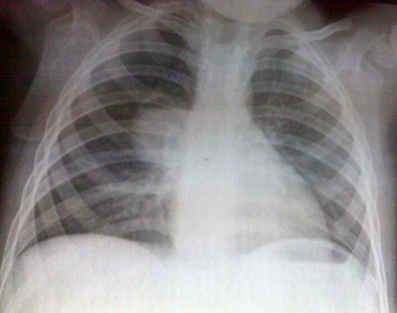 pulmones QUISTE BRONCOGENICO