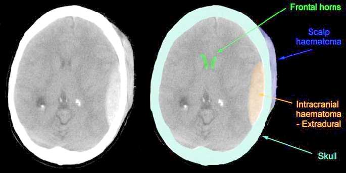 Normal+ct+scan+brain