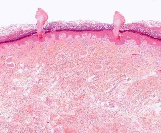 Porokeratosis Treatment