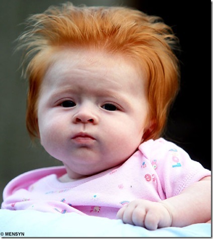 down syndrome ginger