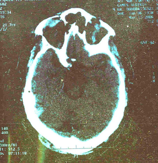 Ct+scan+brain+damage