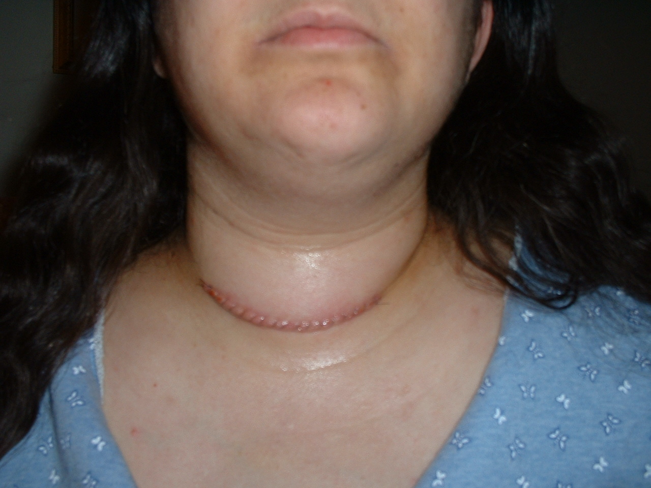Poppetree Scar from thyroidectomy.
