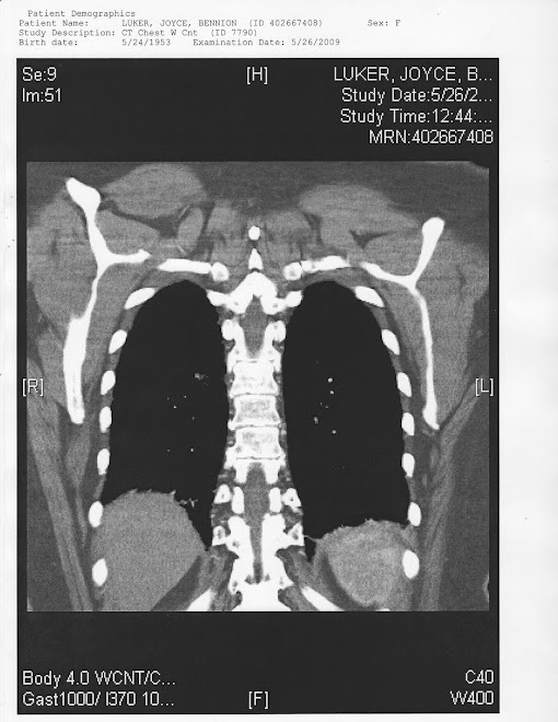 Scan after chemo: 05/26/09