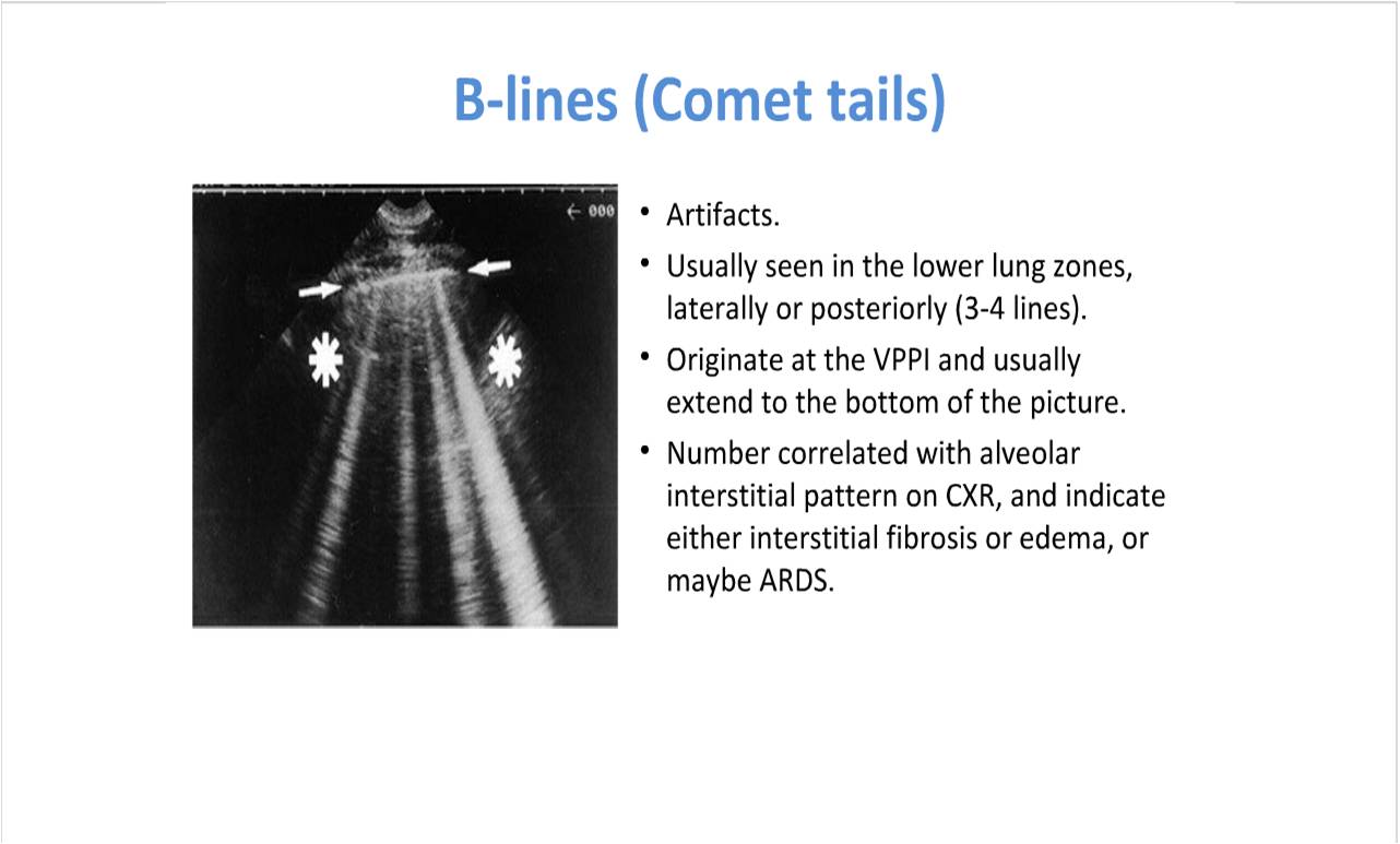 BÀI SOẠN VỀ SIÊU ÂM CHẨN ĐOÁN ALINES, BLINES and AIR ARTIFACTS