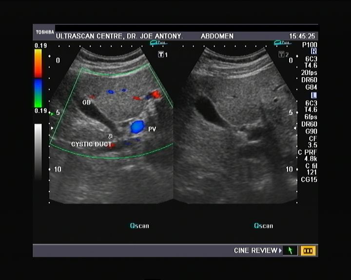common bile duct ultrasound. with the common bile duct.