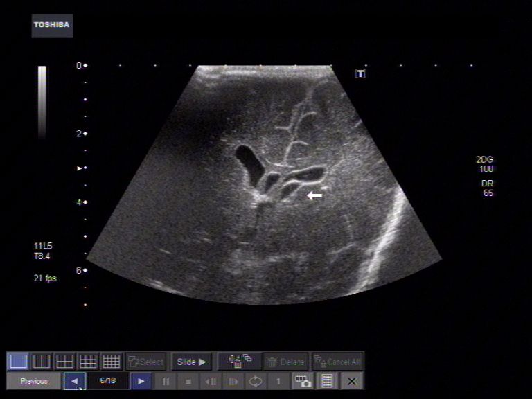 Ultrasound Brain