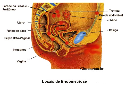 [endometriose_local.jpg]