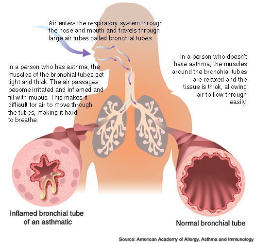 ఊపిరితిత్తుల వ్యాధులు , Lung diseases