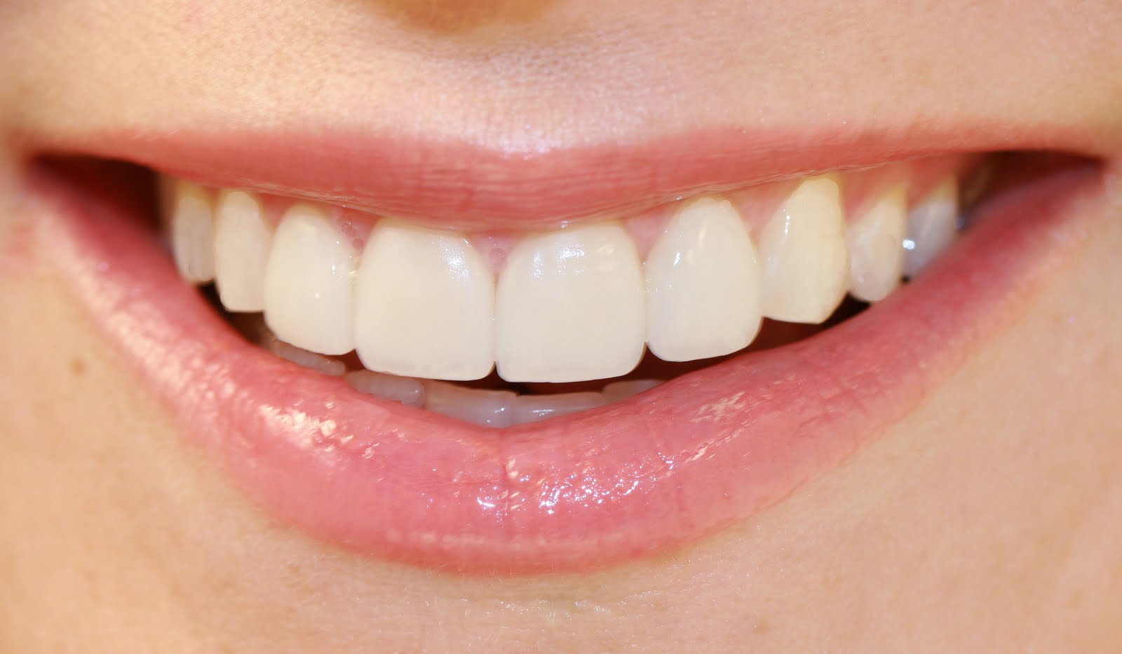 Dental Veneers Pictures