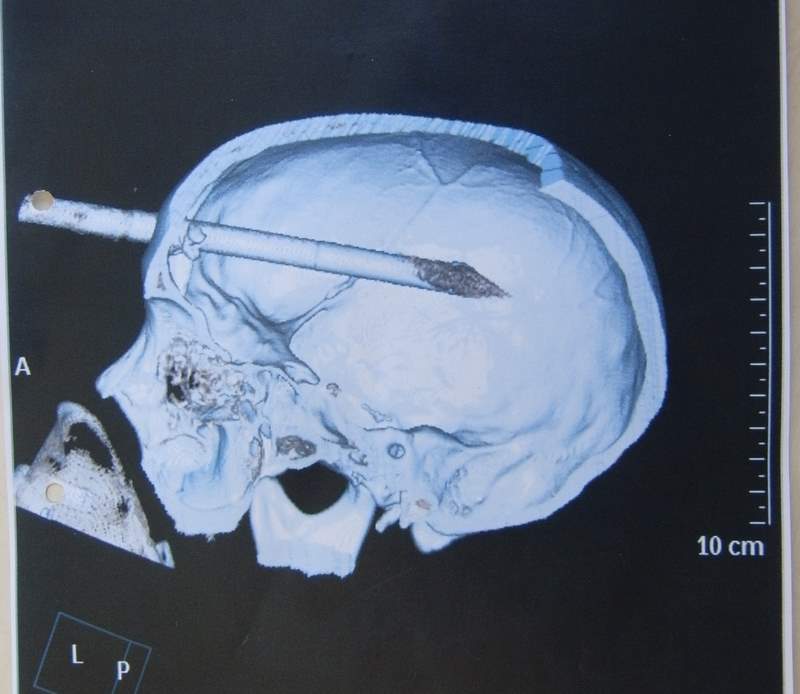 Ct+scan+brain+damage