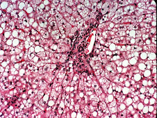 Esteatosis hepática (lagomorfo)