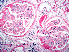 Glomerulonefritis membranosa (canino)