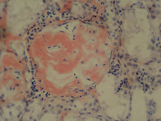 Amiloidosis cortical renal (Rojo congo)