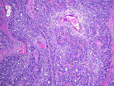 Carcinoma de glándulas sebáceas