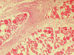 Miositis eosinofílica