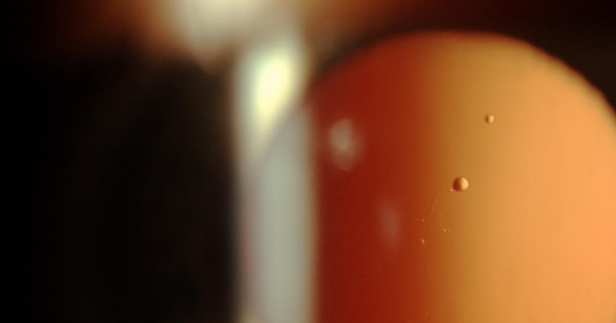 Sonoran Desert Eye Center More Lens Vacuoles