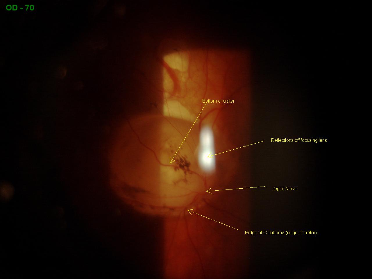 optic nerve coloboma meddic