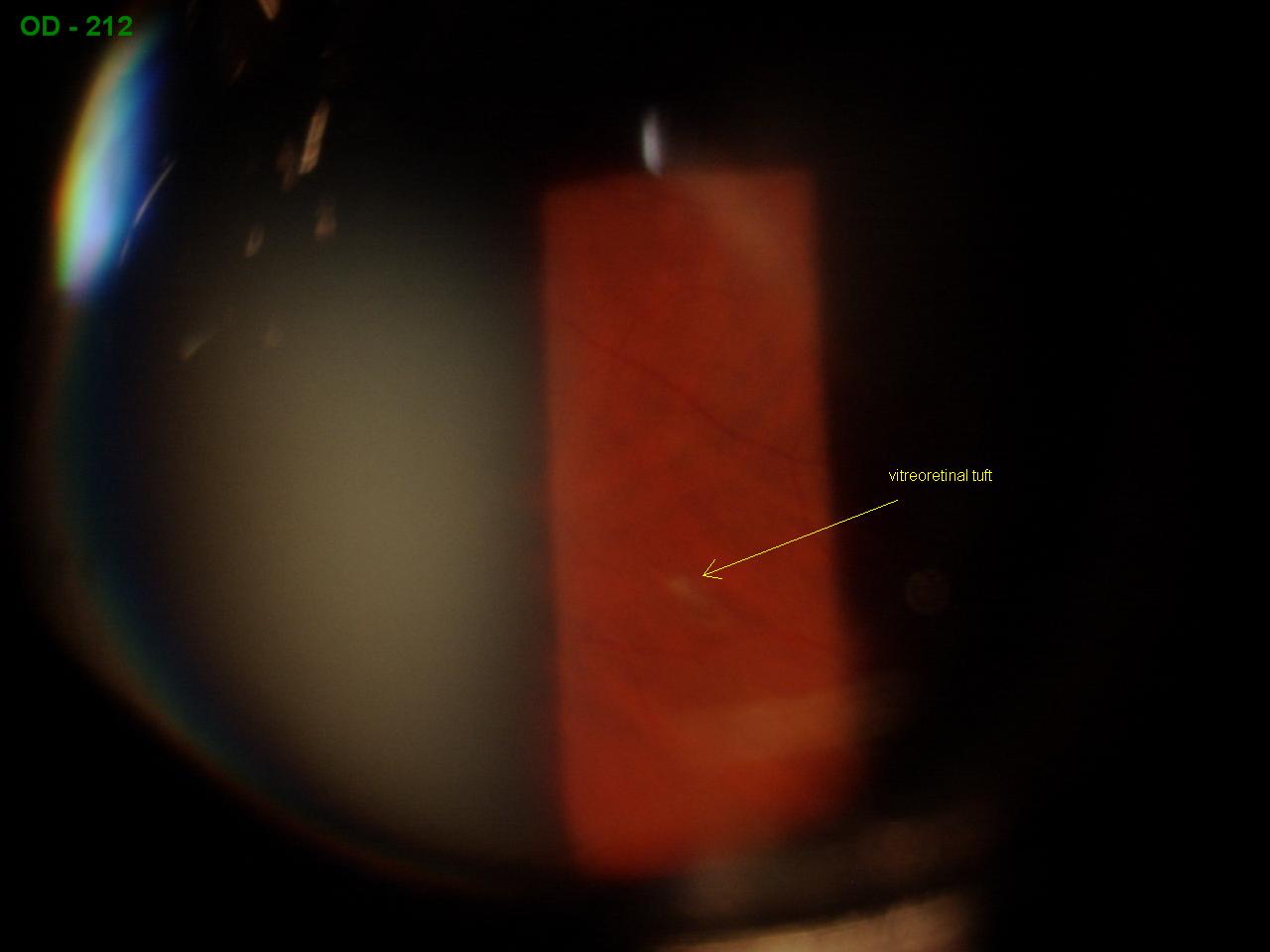 Sonoran Desert Eye Center MYELINATED NERVE FIBERS AND VITREORETINAL TUFT