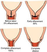 Cervix Shortening