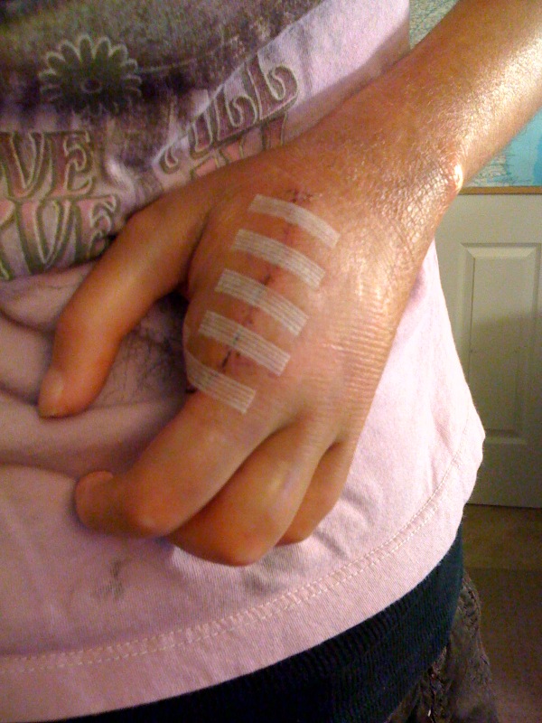 Finger Amputee