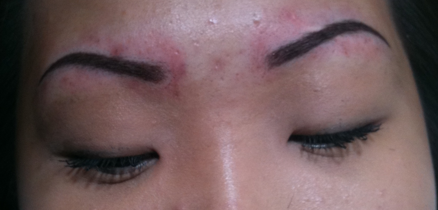 Beauty And The Bees Eyebrow Has A Scar?