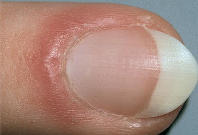 Dark lines beneath the nail should be investigated as soon as possible