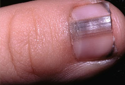 Nail biting or picking has also been linked to obsessive-compulsive disorder