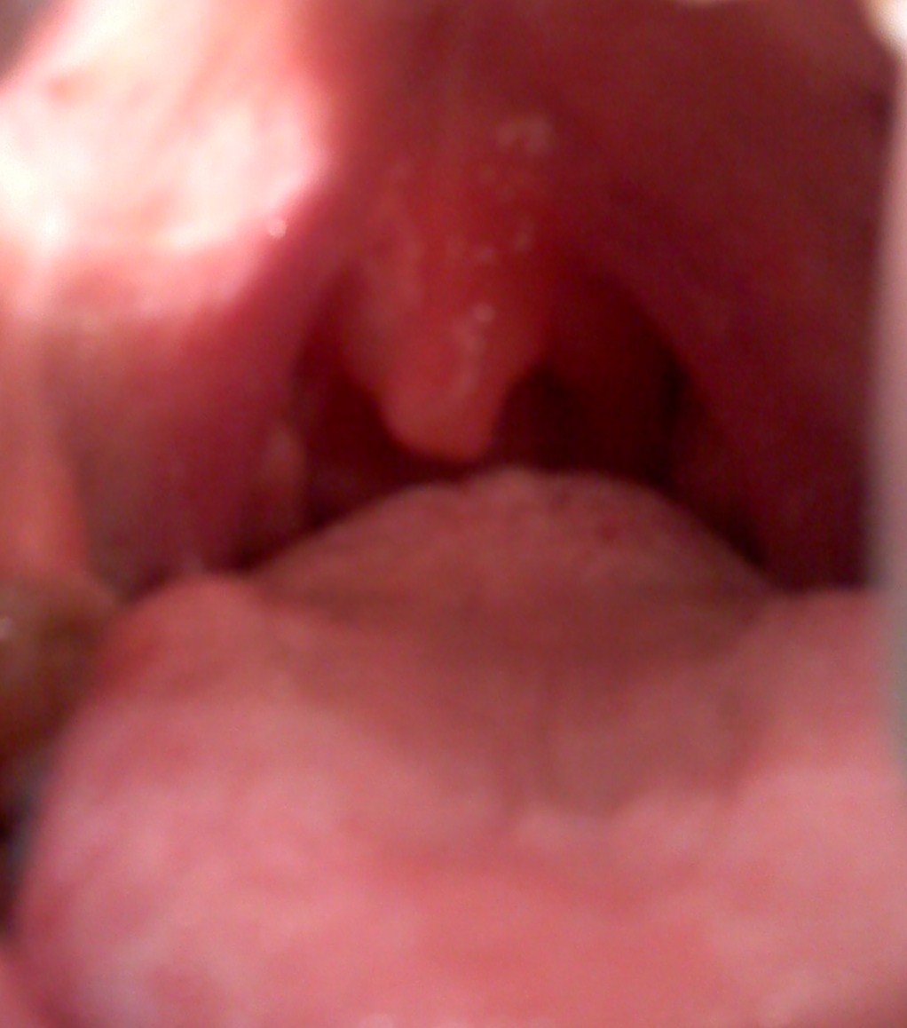 Hangy Thing In Throat 68