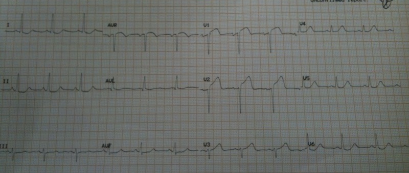 Anterior Stemi Ecg