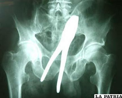 radiografias-alicate-en-el-ano-operacion-quirurgica.jpg