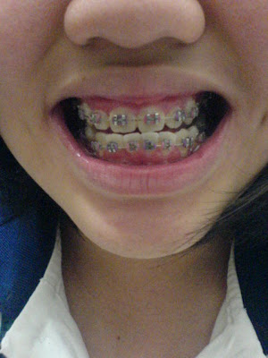 Cute Braces Colors