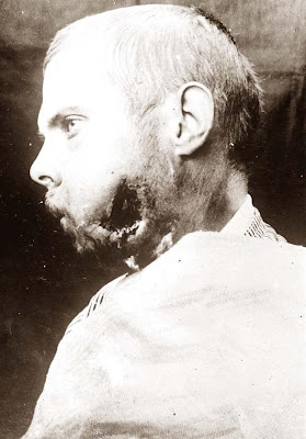 World+war+1+soldiers+wounded