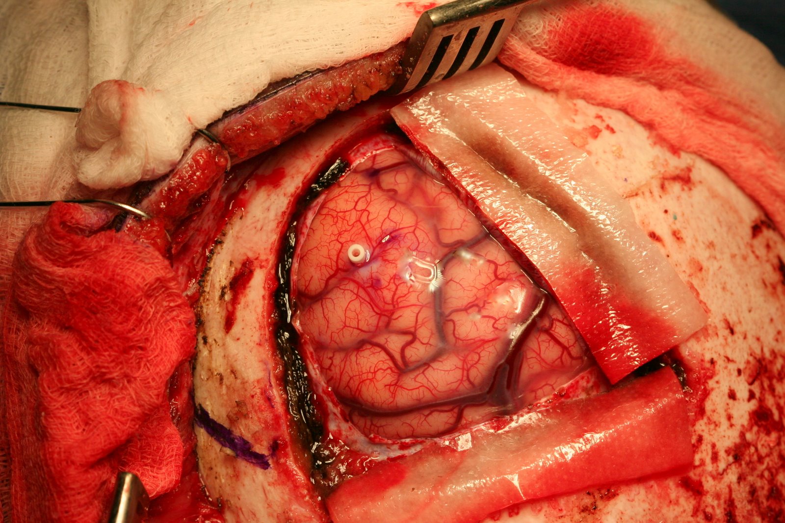 Frontal Lobe Epilepsy