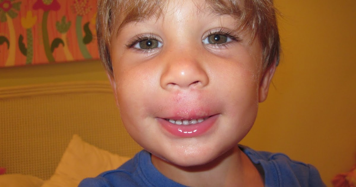 the dunn's 1st Busted Lip