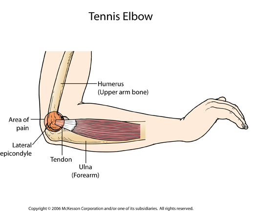 Tennis Elbow Exercises Chart