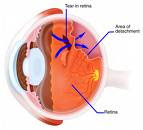 ABLASI RETINA