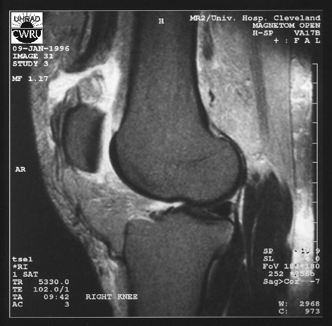 RadiologySpirit Quadriceps Tendon Tear,