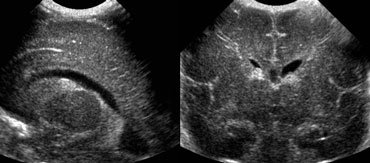 Subependymal Hemorrhage