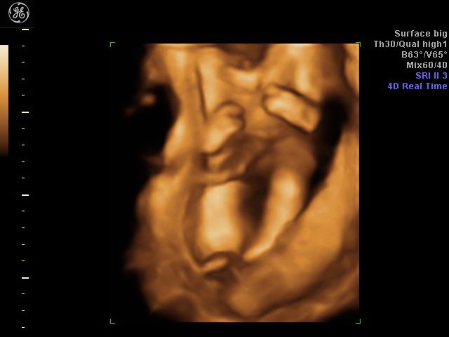 When can babies sex be determined by ultrasound