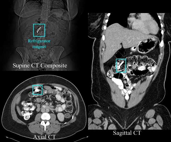 Bowel Contusion Perforation