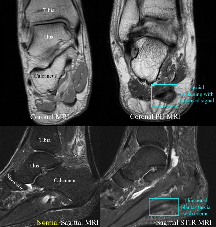 Foot Arch Pain