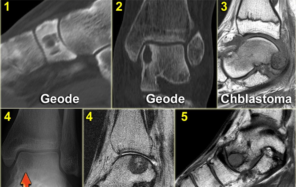 RadiologySpirit bone tumors of foot