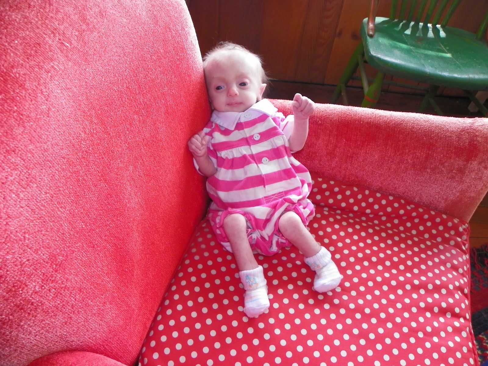 Pray For Lilly Lilly's Trisomy 18 physical features