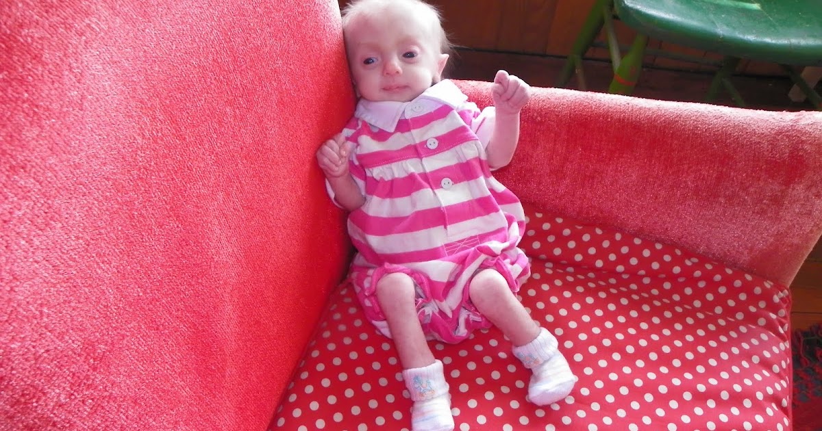 Pray For Lilly Lilly's Trisomy 18 physical features