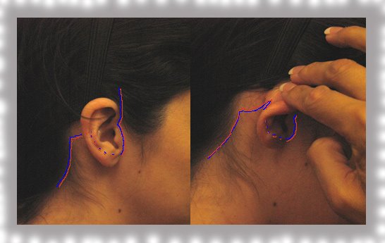 [facelift-ear-1.jpg]